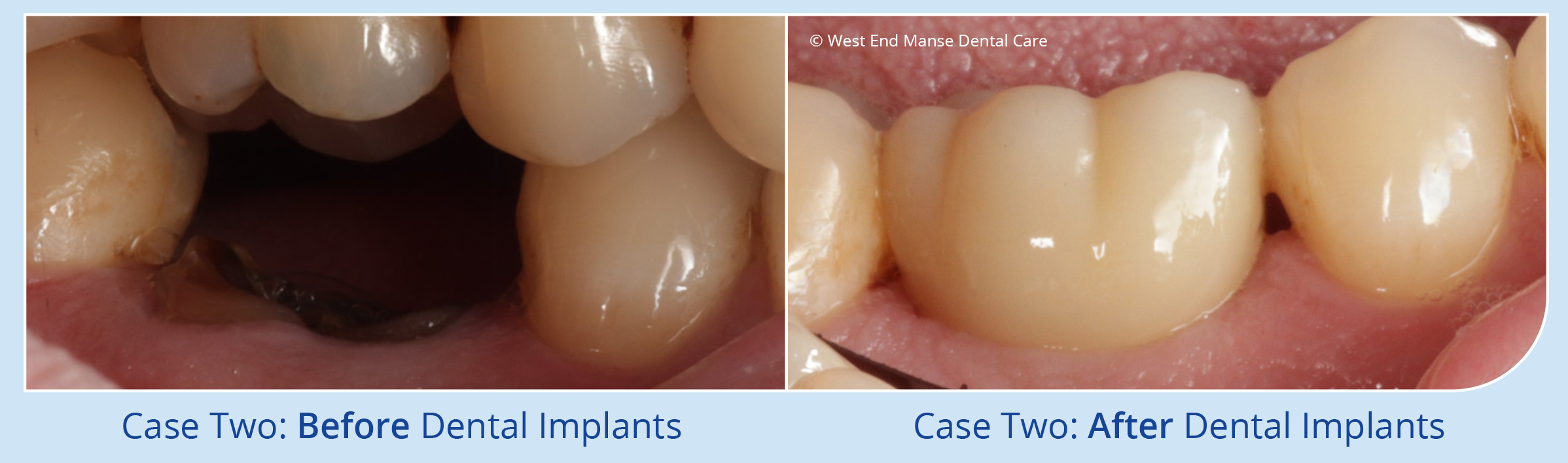 Haverhill Dental Implants